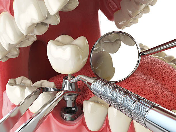 Best Emergency Dental Extractions in Webster, TX